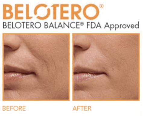 belotero dermal filler